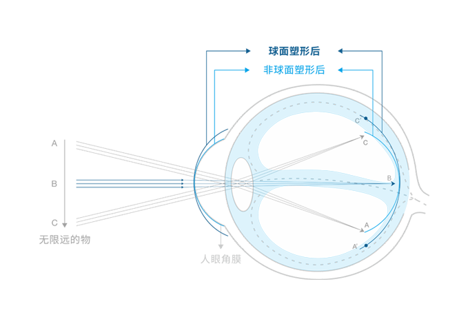 普诺瞳角膜塑形镜